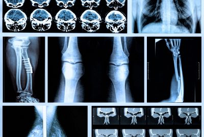 Radiography,Of,Human,Bones